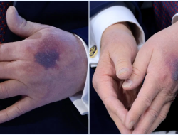 Donald Trump Ungkap Penyebab Tangan Memar di Davos: Aspirin atau Benturan?