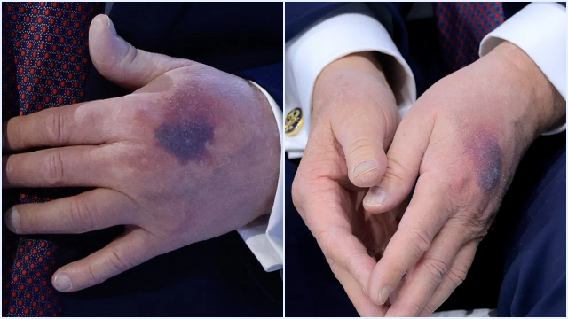 Donald Trump Ungkap Penyebab Tangan Memar di Davos: Aspirin atau Benturan?